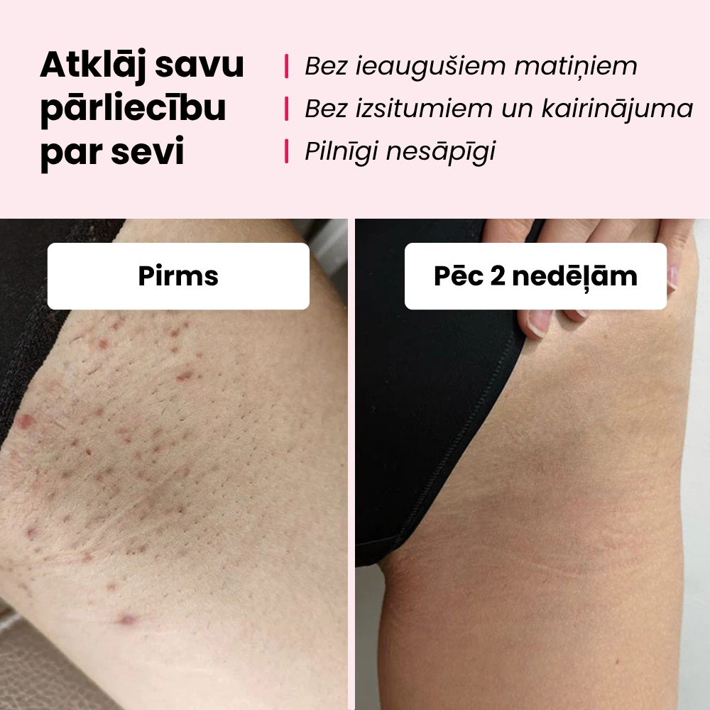 Glowie™ matiņu noņemšanas komplekts