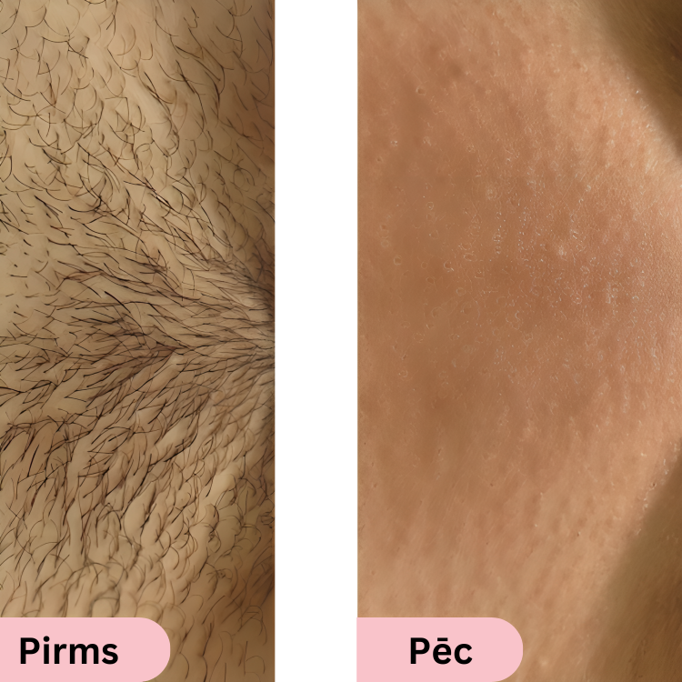 Glowie™ IPL fotoepilators – matu noņemšanas ierīce