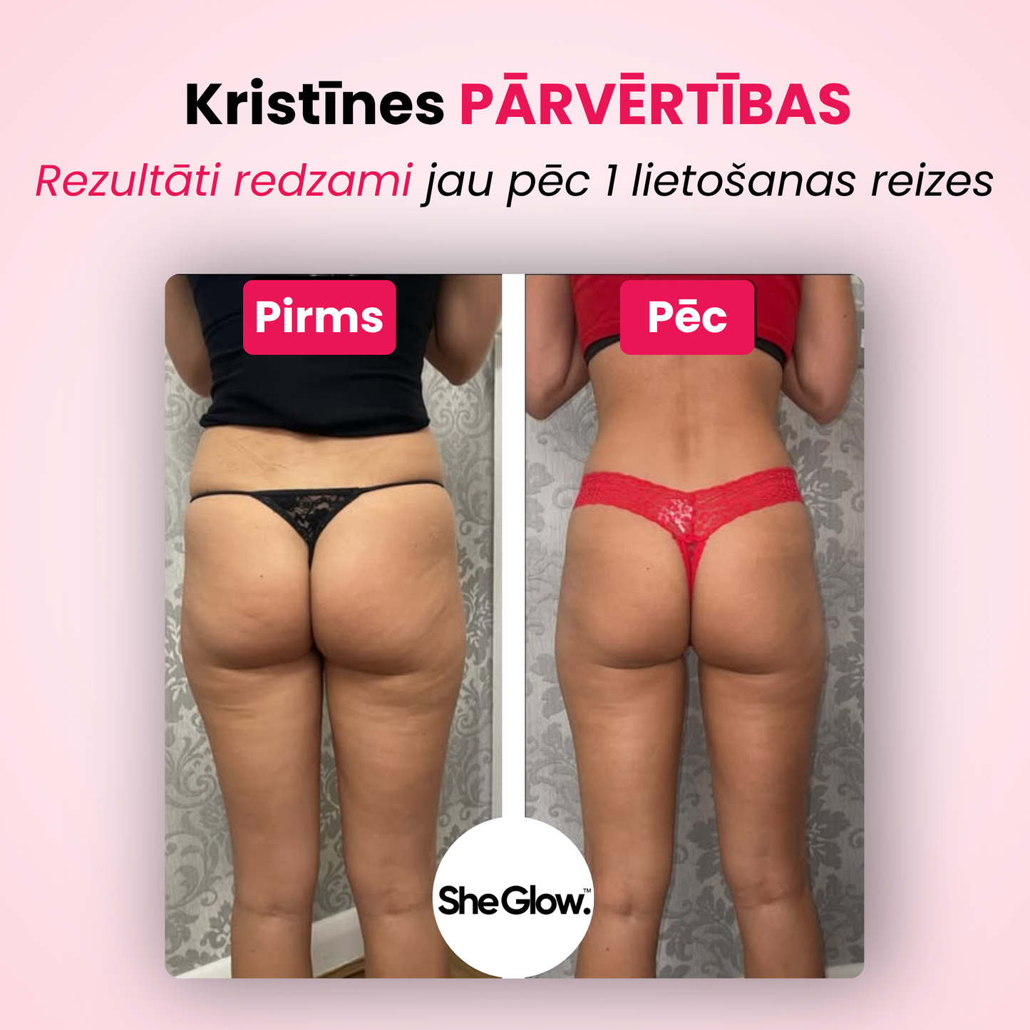 SheGlow pretcelulīta ierīces rezultāti – pirms un pēc foto ar redzamiem uzlabojumiem jau pēc pirmās lietošanas reizes