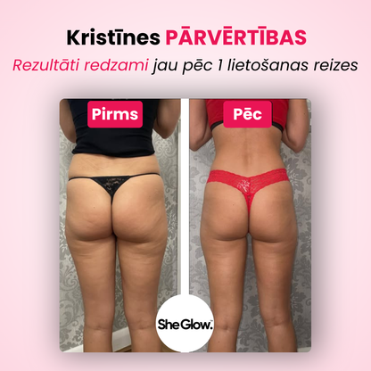 SheGlow pretcelulīta ierīces rezultāti – pirms un pēc foto ar redzamiem uzlabojumiem jau pēc pirmās lietošanas reizes
